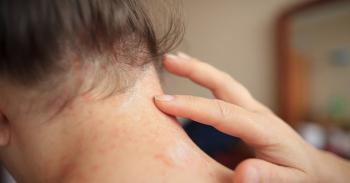 Zerdeçal özütü Sedef hastalarında şikâyetlerin kontrolünde güvenilir bir seçenek